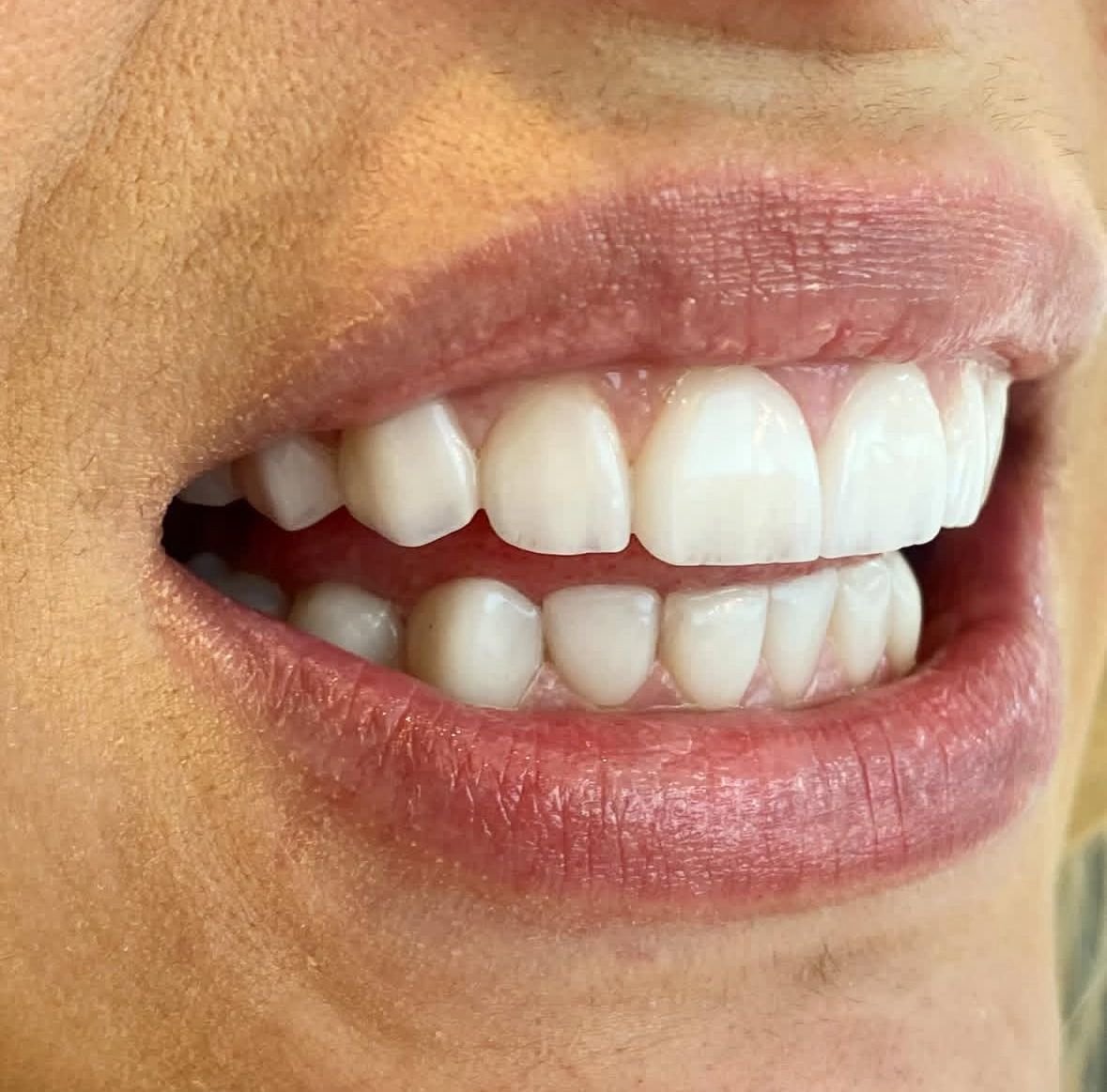 Sorriso com facetas em resina