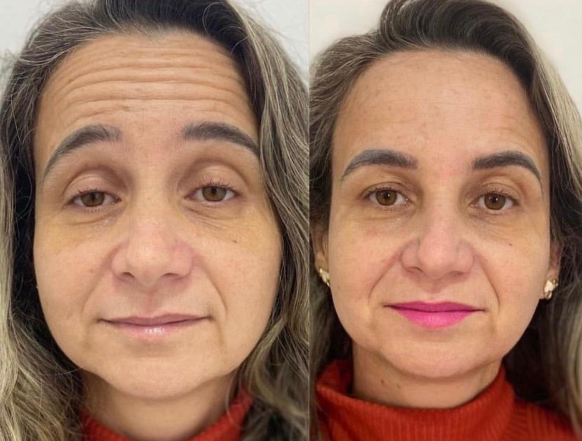 Antes e depois de tratamento facial
