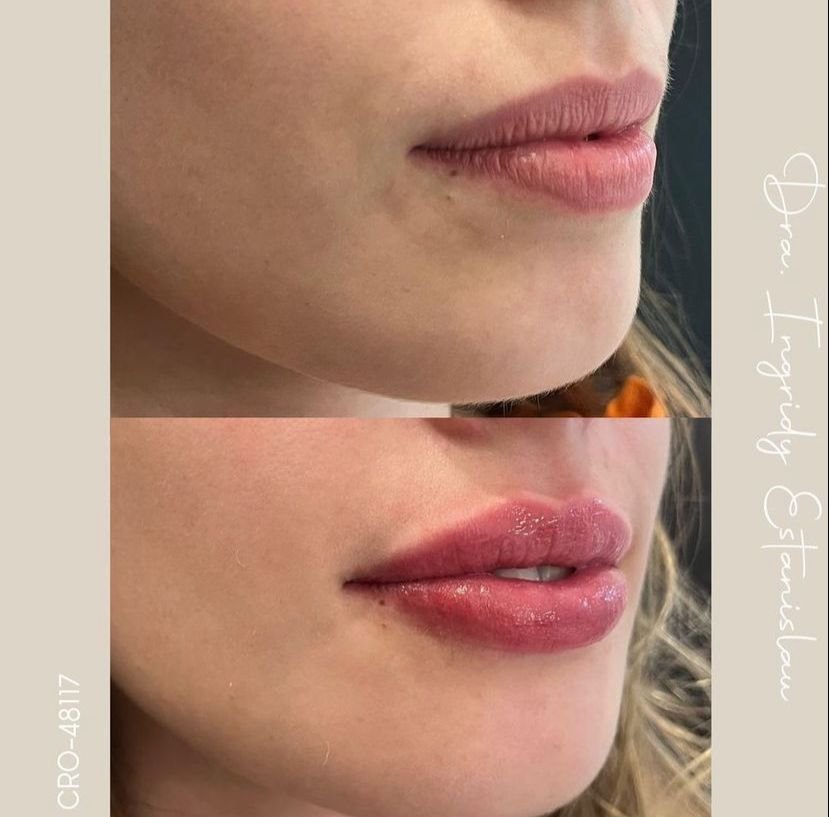 Antes e depois de harmonização facial
