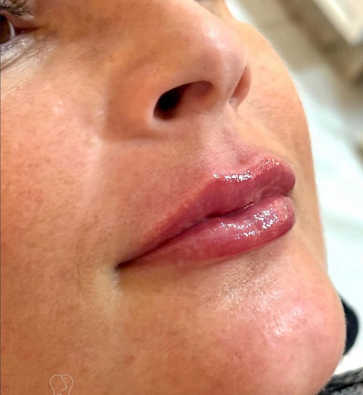 Resultado de preenchimento labial