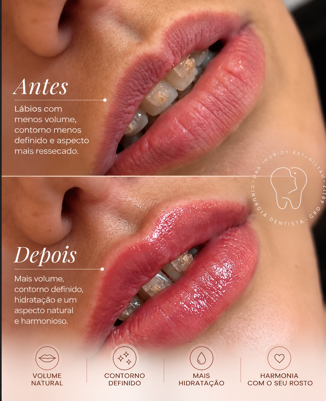 Resultado de preenchimento labial